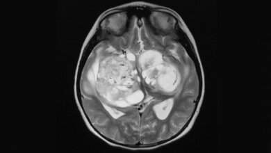 Gliom_CC_BY_SA_2_0_Griselda_Ramirez_12042016.jpg Diffuses Gliom
