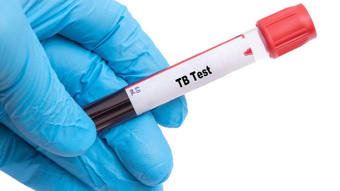 Neuer Kindertuberkulosetest soll schnellere Ergebnisse liefern.