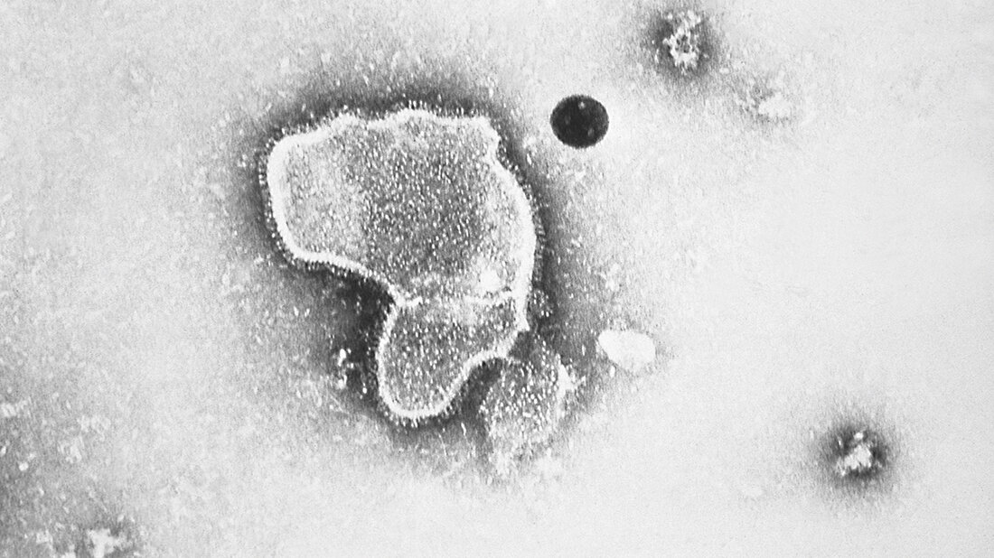 Dramatische Zunahme von Erkältungskrankheiten Mikroskop-Bild des Respiratory-Syncytial-Virus