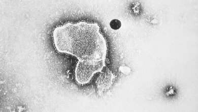 Dramatische Zunahme von Erkältungskrankheiten Mikroskop-Bild des Respiratory-Syncytial-Virus
