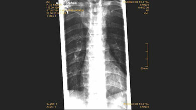 Traumatische Veränderungen: Frakturen der Wirbelfortsätze Bildgebende Verfahren