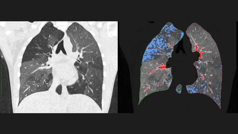 reguläres CT und qCT