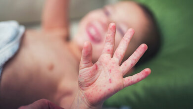 Title picture of the expert article “Hand-Foot-and-Mouth Disease”