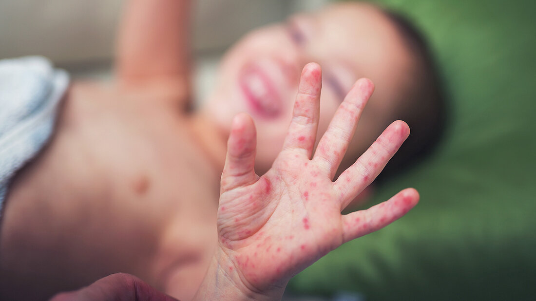 Hand-Foot-and-Mouth Disease Title picture of the expert article “Hand-Foot-and-Mouth Disease”