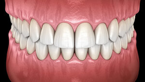 Grafik mit Frontalansicht des menschlichen Gebisses