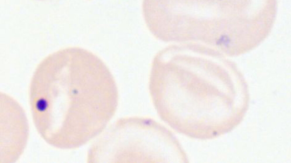 Howell-Jolly-Körperchen