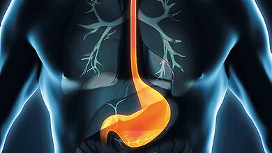 Plummer-Vinson syndrome