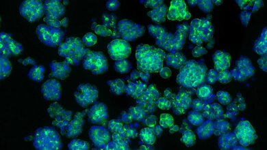Arginin fördern das Tumorwachstum