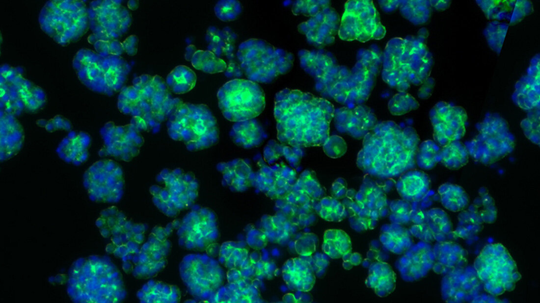 Arginin_Leberkrebs.jpg Arginin fördern das Tumorwachstum