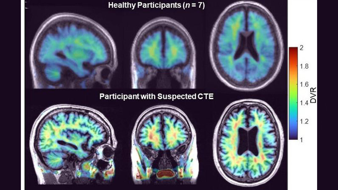 PET-Bilder eines gesunden Patienten versus Patient mit Verdacht auf Chronisch traumatischer Enzephalopathie.