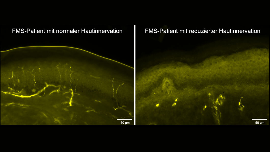 Mittels Stanzbiopsie gewonnene Hautproben 
