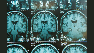 Gefahr durch Implantate im MRT verhindern