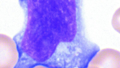 1-LZ_Aufmacher-RWTH_Aachen.jpg Reakive Lymphozyten