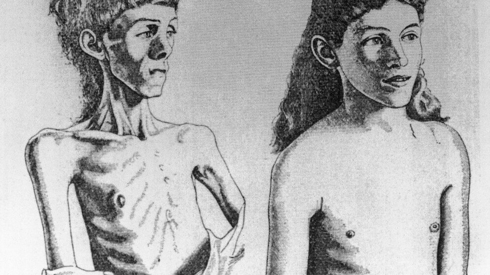 Anorexia_nervosa_Von_wellcomeimages_org_CC_BY_4_0.jpg Mädchen mit Anorexia nervosa
