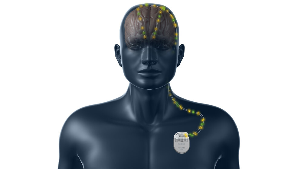 Neurostimulatorsystem 