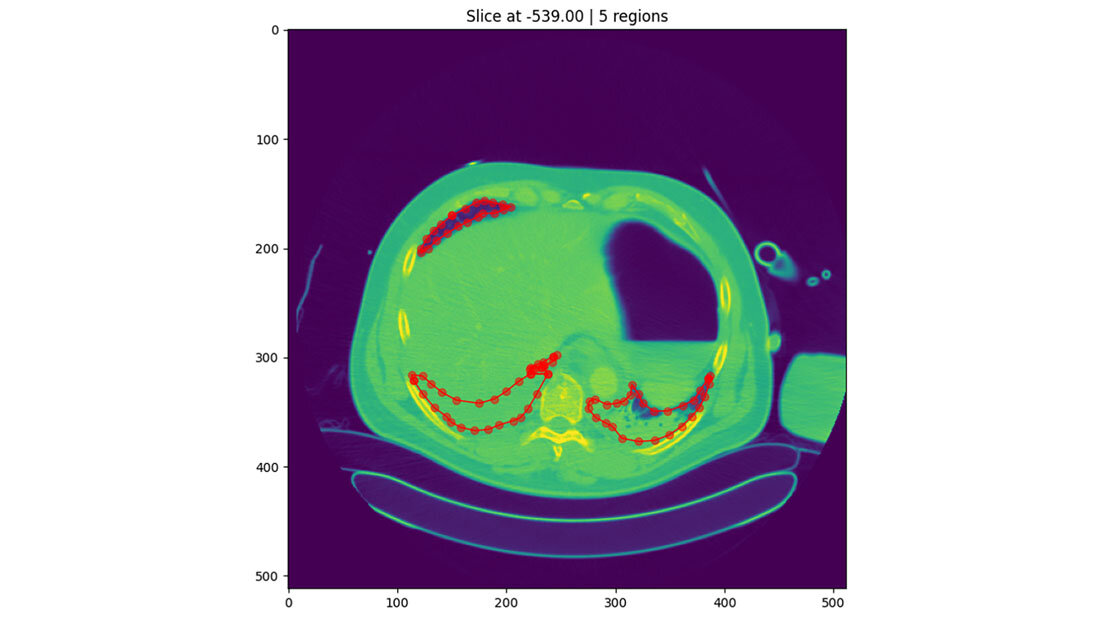 Segmentierung einer Lunge mit Hilfe von KI 