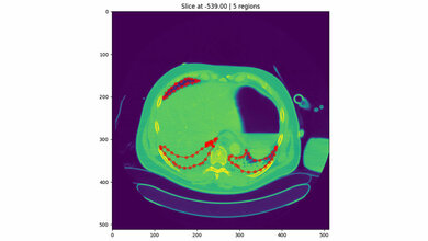 Segmentierung einer Lunge mit Hilfe von KI 