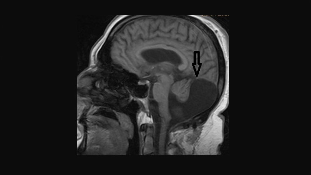 Anomalien und Normvarianten: Zerebrale Malformationen 4.3