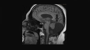 Anomalien und Normvarianten: Zerebrale Malformationen 4.3