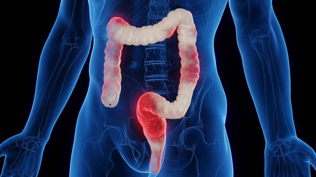 3D-Darstellung von Darmentzündungen