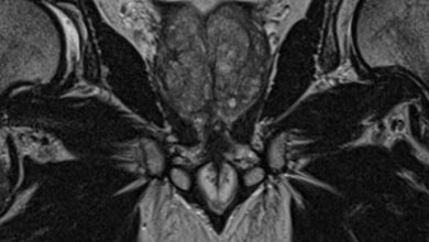 Hochaufgelöste T2 in coronarer Ausrichtung