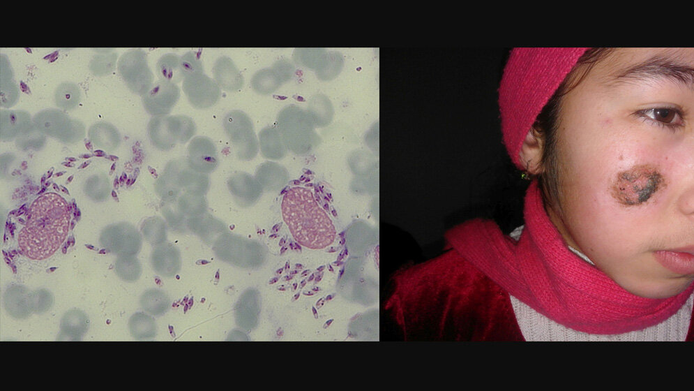 Mikroskopischer Nachweis von Leishmanien