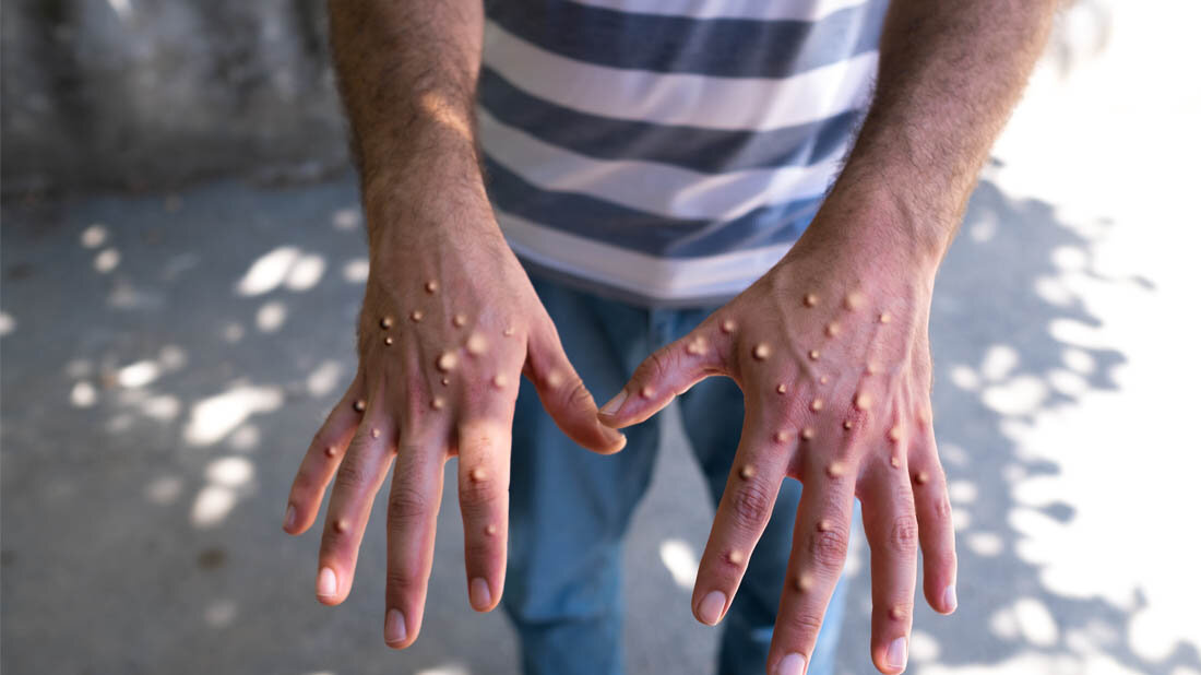 Mpox_Haende.jpg Hände mit Mpox