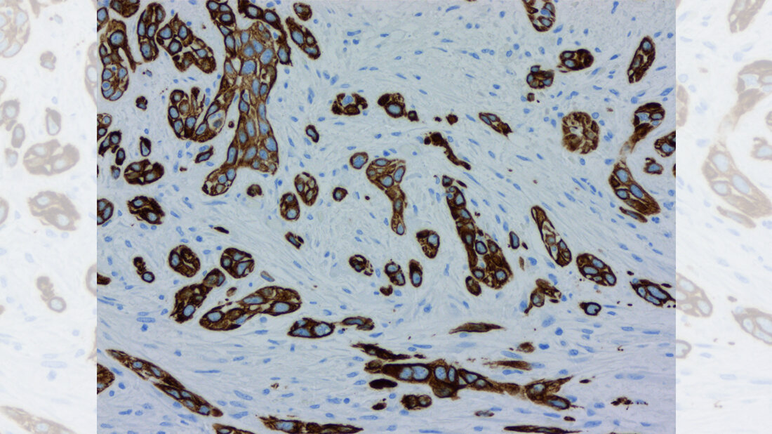 Keratin-7-Färbung eines Bauchspeicheldrüsentumors 
