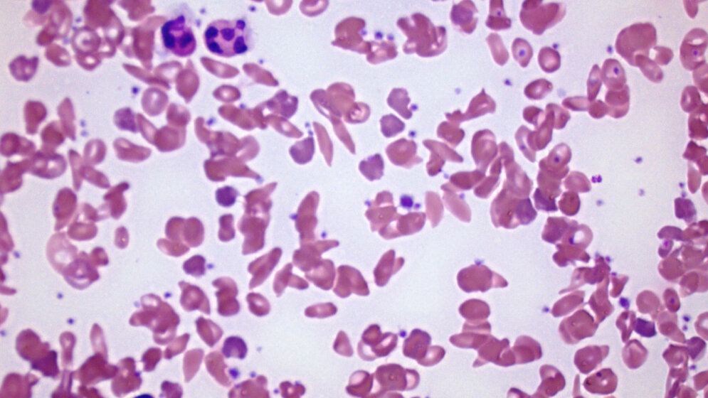 Blutausstrich bei Sichelzellanämie