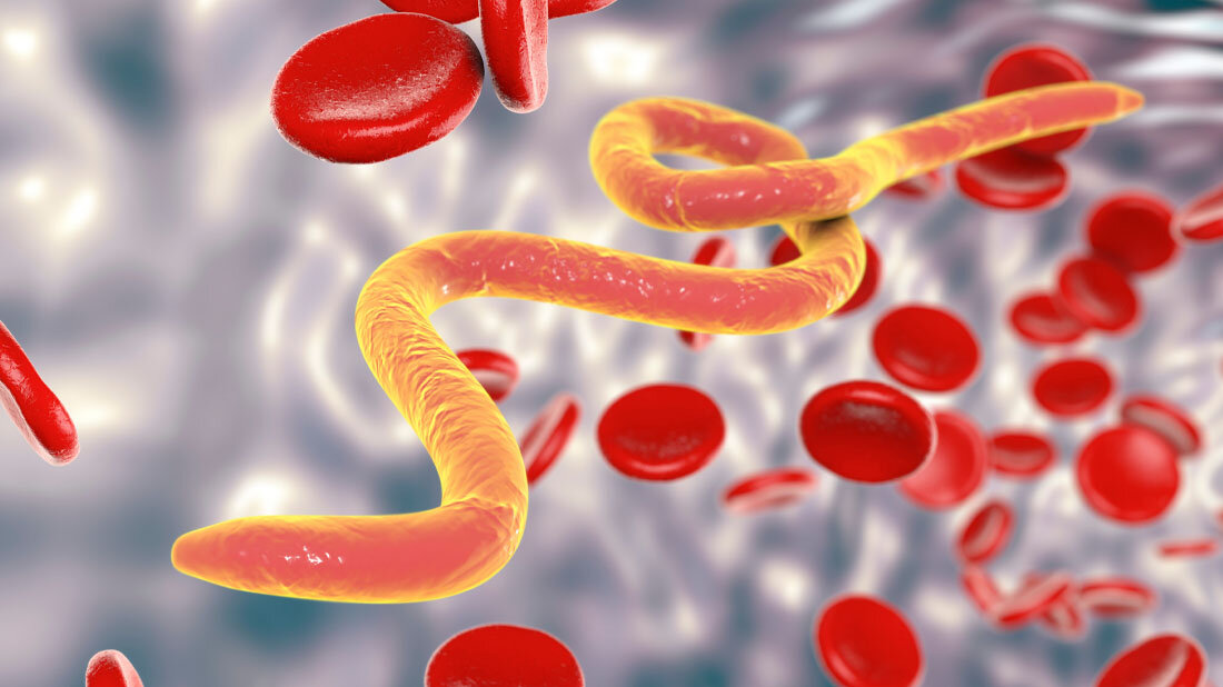 Infektion mit Würmern aus der Gruppe der Filarien