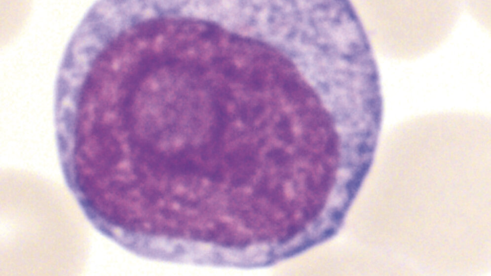Das auffälligste Merkmal der Prolymphozyten ist der prominente Nukleolus.