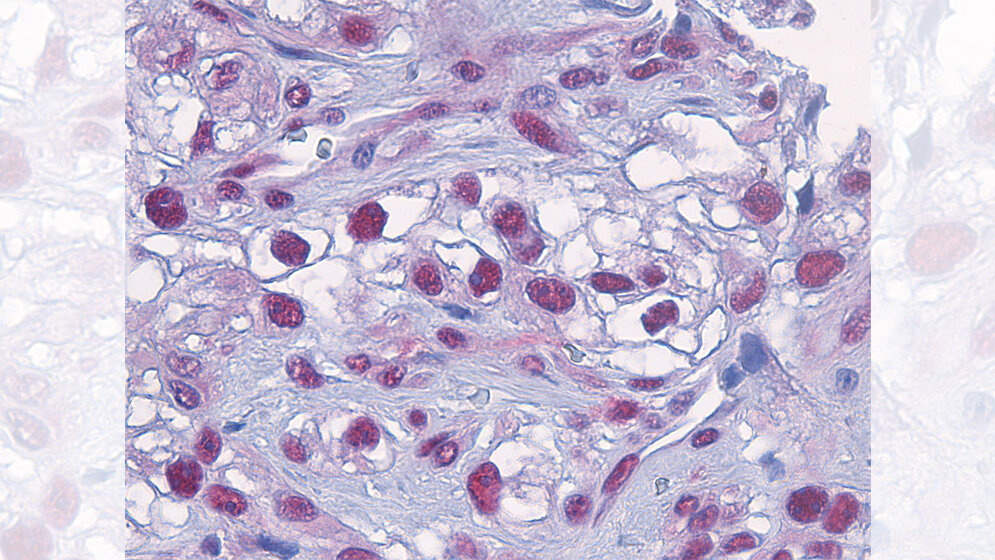 Blick in Tumorgewebe des malignen Melanoms