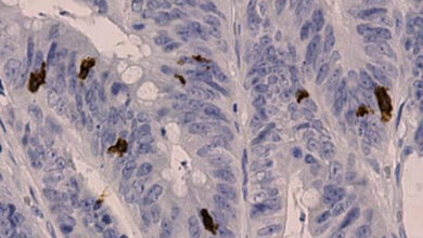  KI-basiertes Prognosemodell für Dickdarmkrebs ermittelt ‚Almmunoscore‘ aus einer Vielzahl von mikroskopischen Bildern des Tumorgewebes 