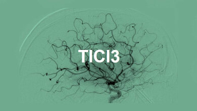 Reperfusion nach Gabe von Urokinase
