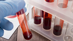 The most important blood tests (II)