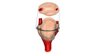 paraganglioma
