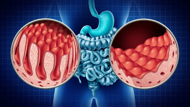 Zöliakie auf die Spur kommen