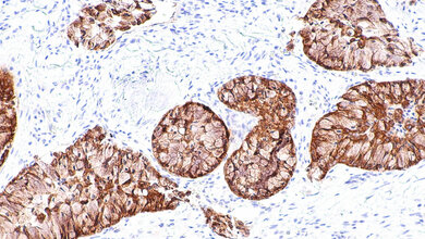 ALK-positives Adenokarzinom