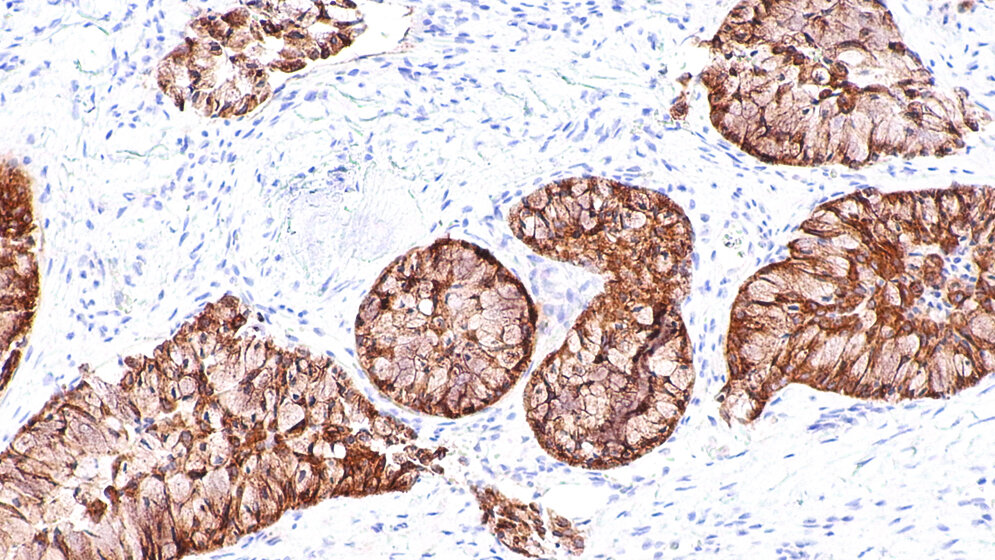ALK-positives Adenokarzinom