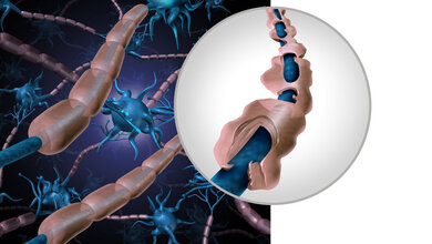 Symbolische Darstellung der Zerstörung der Myelinschicht bei MS.