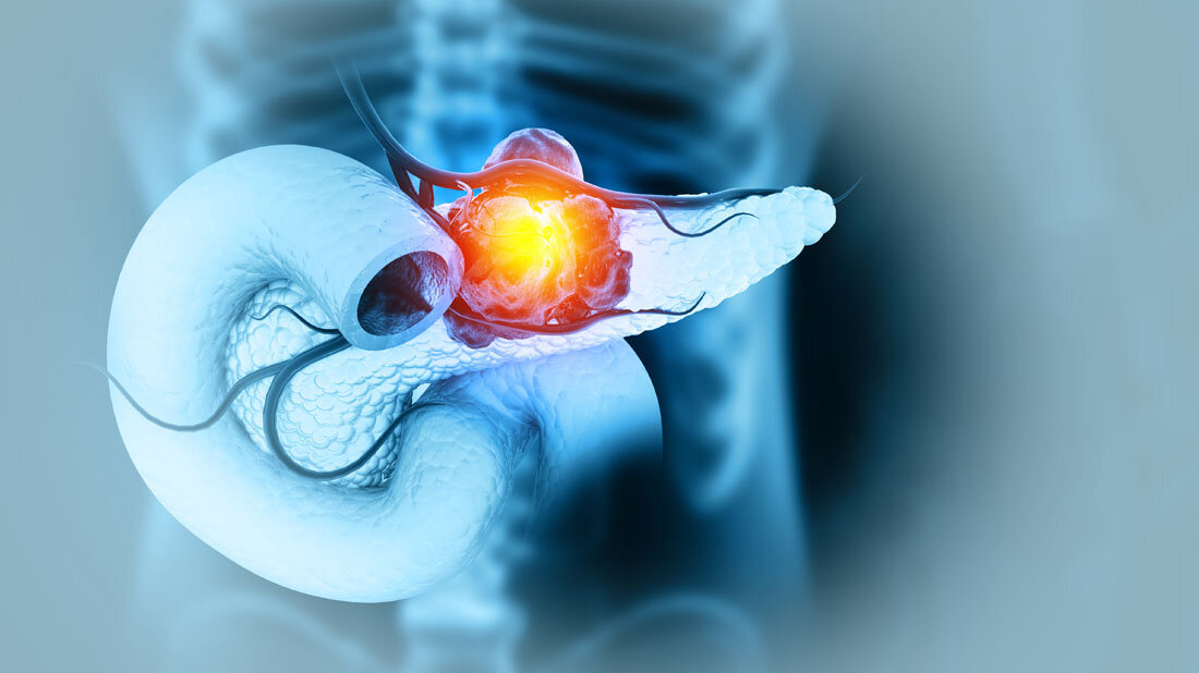 Pankreaskarzinom_Bluttest.jpg Pankreaskarzinom