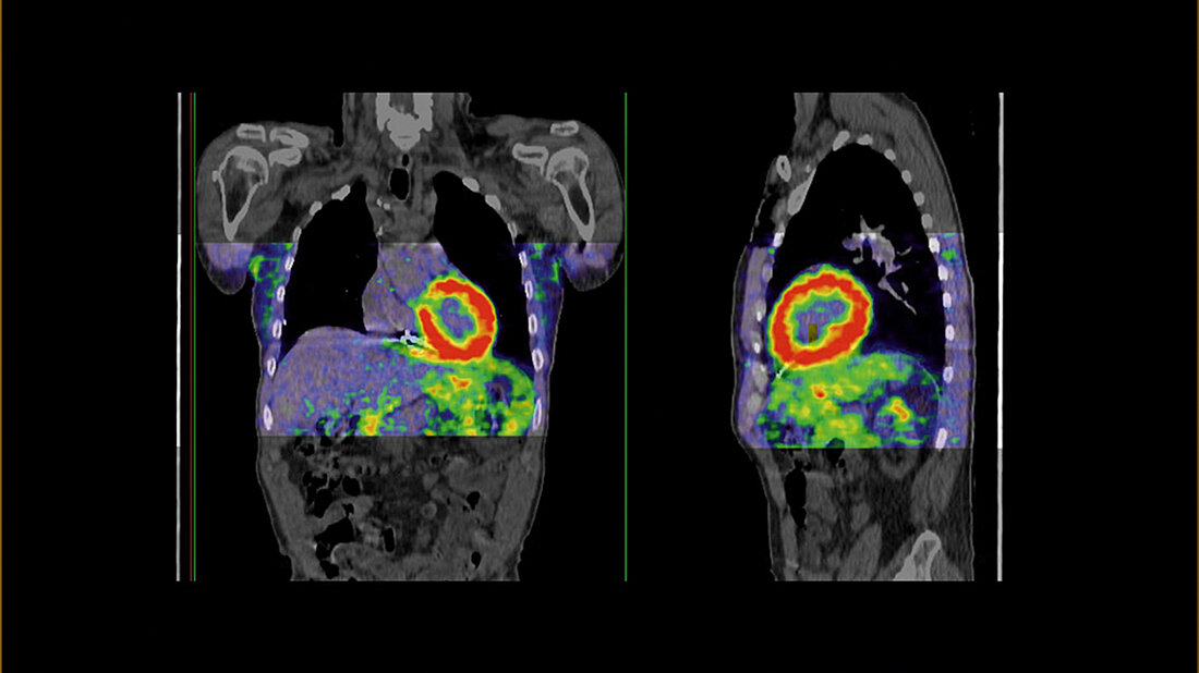 PET-Tracer Iodine-124 Evuzamitide PET-CT-Scan zur Diagnose einer kardialen Amyloidose des Herzens