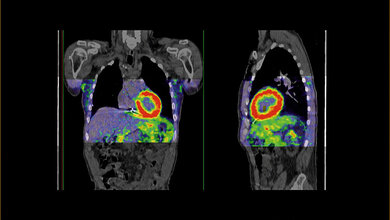 PET-CT-Scan zur Diagnose einer kardialen Amyloidose des Herzens