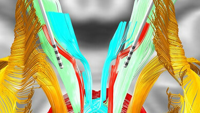 iteratur tiefe Hirnstimulation