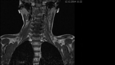 Bildgebende Verfahren Arnold-Chiari-Malformation