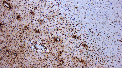 Demyelinisierung bei MS