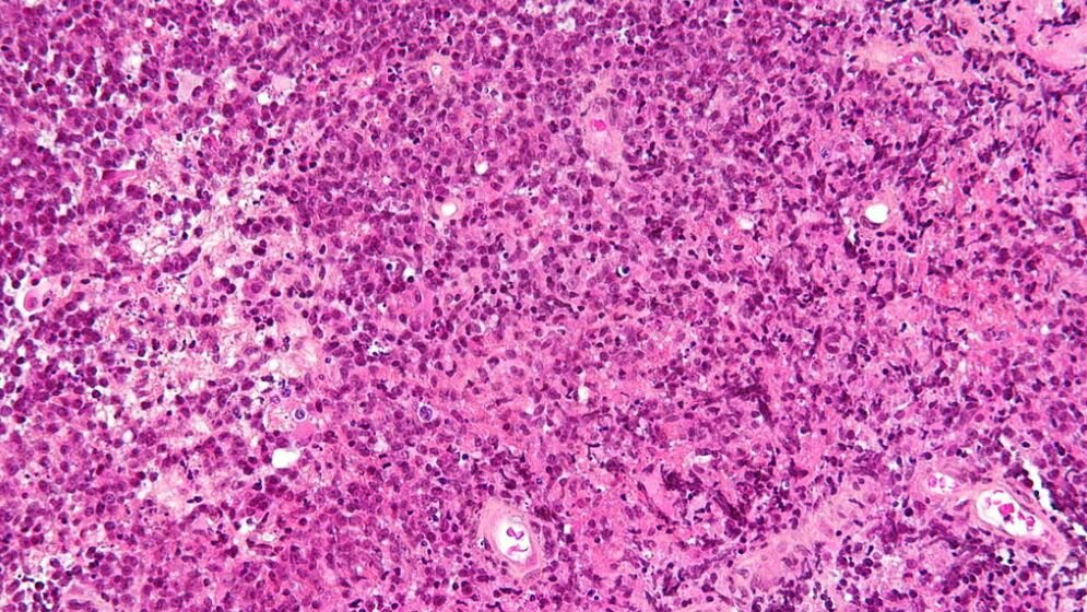 Primäres ZNS Lymphom