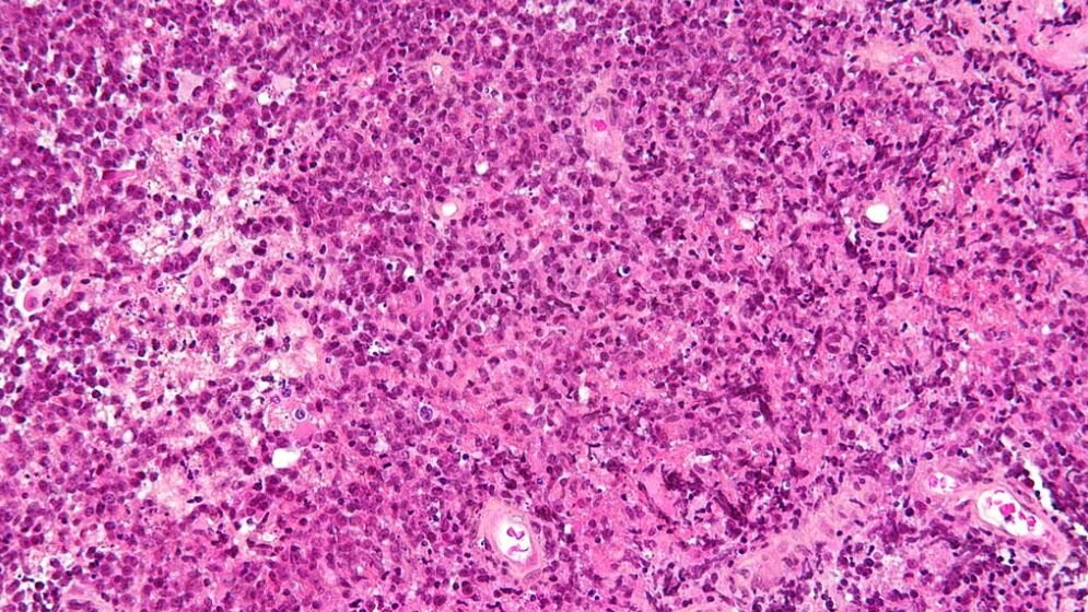 Primary_CNS_lymphoma_von_Nephron_CC_BY_SA_3_via_Wikimedia_Commons_23032016.jpg Primäres ZNS Lymphom