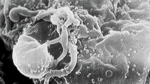 HIV-Patienten auf der Intensivstation