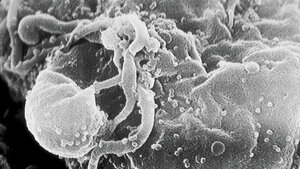 HIV-Patienten auf der Intensivstation